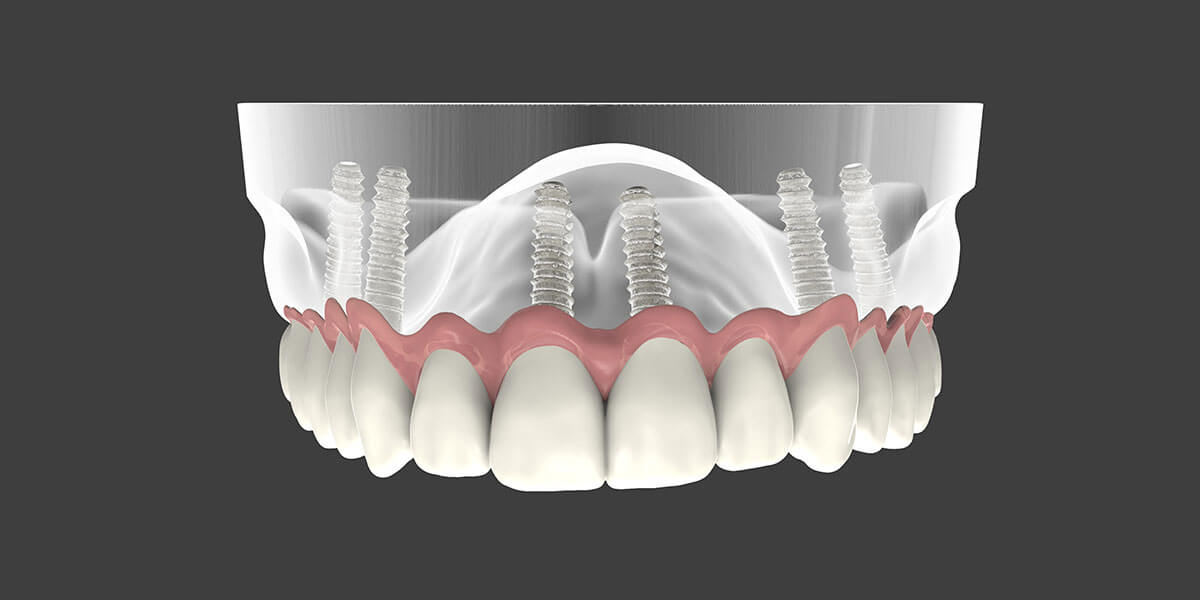 Implant Supported Dentures Page Image