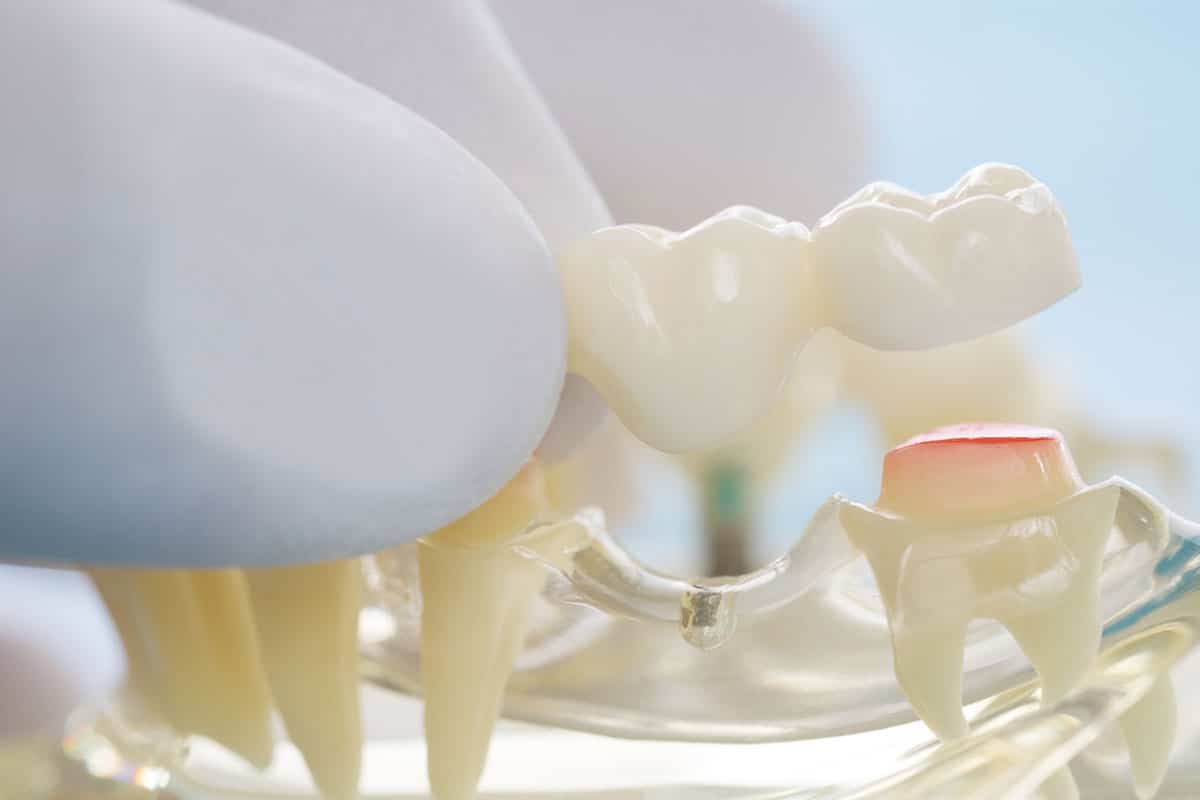 How Long Do Dental Bridges Last Blog